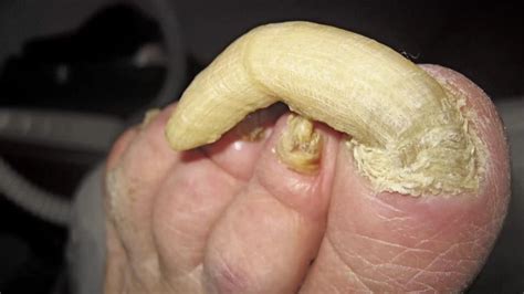 How Effective is Apple Cider Vinegar for Toenail Fungus? | Cure Toenail Fungus Fast