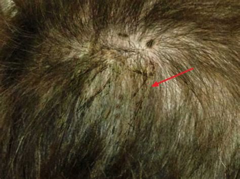 Black piedra, causes, symptoms, diagnosis, treatment & prognosis