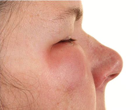 Periorbital Cellulitis