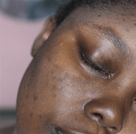 Revealing Radiance: Comprehensive Guide to Skin Pigmentation ...