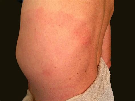 Ringworm Rash On Stomach