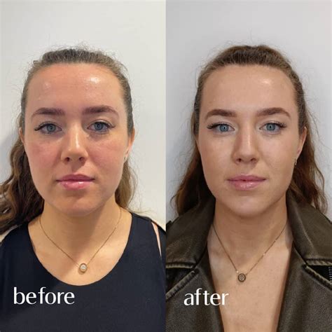 Masseter Botox Treatment - Eden Medical Clinic