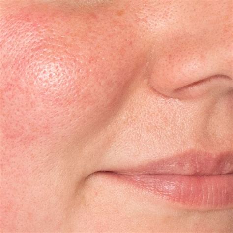 Rosacea On Chest