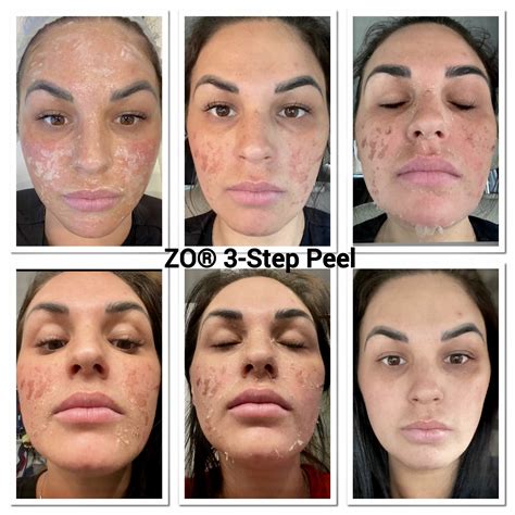 ZO Skin Chemical Peel Treatment — Bombshell Aesthetics