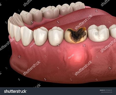 Periostitis Tooth Lump On Gum Above Stock Illustration 1975326131 | Shutterstock
