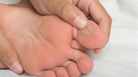 Cómo curar ampollas en los pies: guía práctica paso a paso