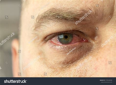 Watery Eyes Allergies