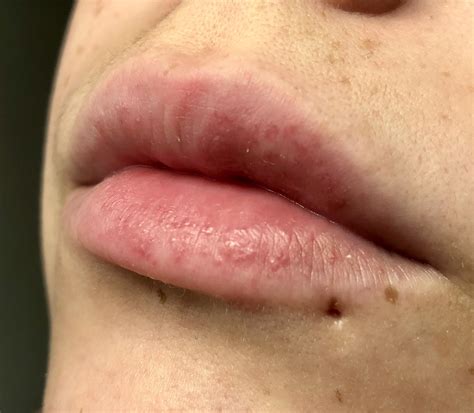 Allergic Reaction On Lips