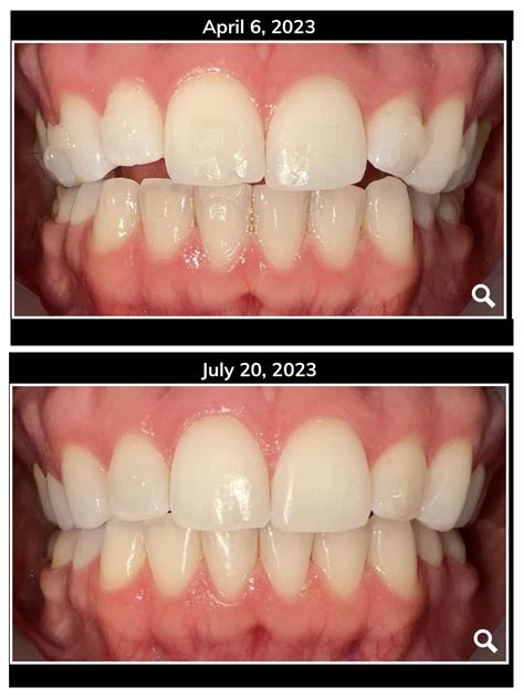 It seems like my bite has gotten deeper. At what point does it go from a “healthy bite” to a ...