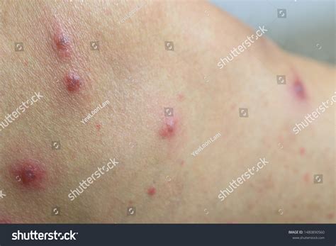 Skinbumpslumpsblisters Caused By Insect Sandfly Bites Stock Photo ...