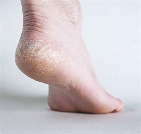 Why Are My Feet Peeling? - Feet First Clinic
