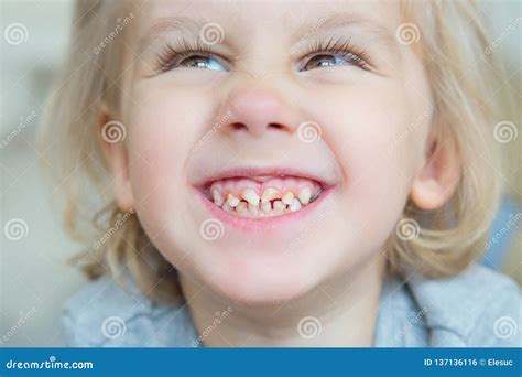 Kids Bad Teeth