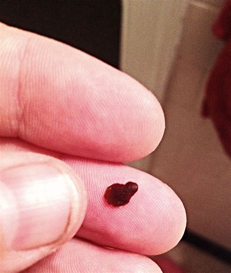 How Big Is 1 Cm Kidney Stone - Design Talk