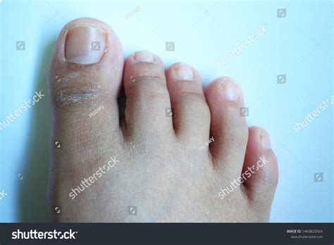 Dry Skin On My Toe Nail