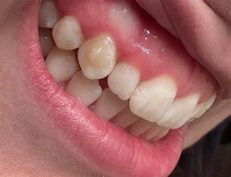Attachment stain or dying tooth? : r/Invisalign