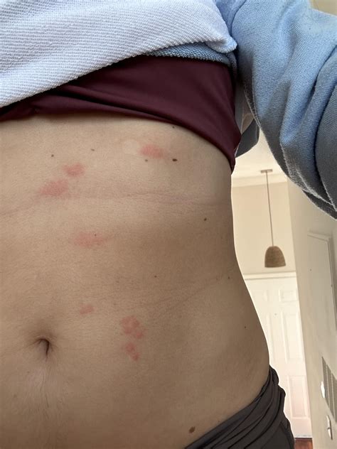 Itchy Rash On Stomach