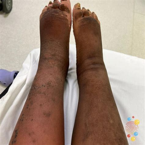 Lymphedema Elephantiasis