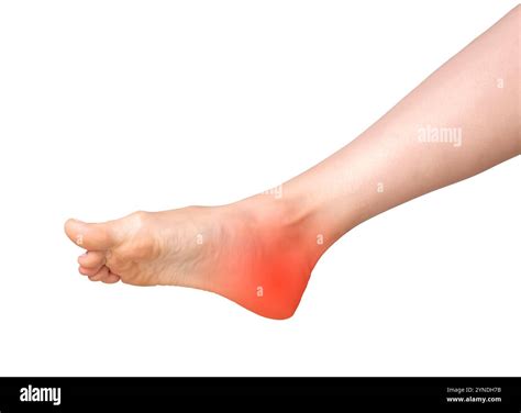 Heel pain, joint inflammation from arthritis or neuropathy. Inflamed ...