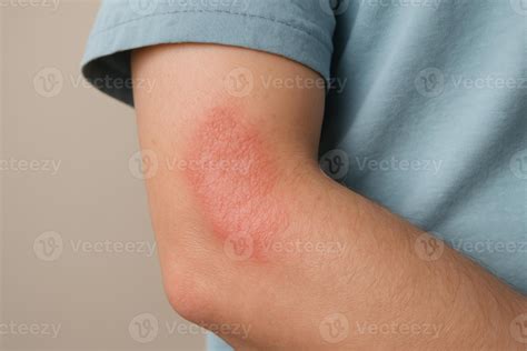 Red, irritated skin rash on a man inner elbow, showing dry and scaly ...