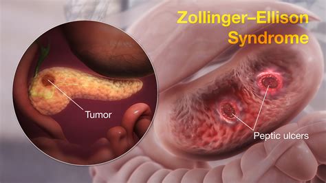 WHAT IS ZOLLINGER-ELLISON SYNDROME: SYMPTOMS, CAUSES, DIAGNOSIS, AND MORE - Chiid Health