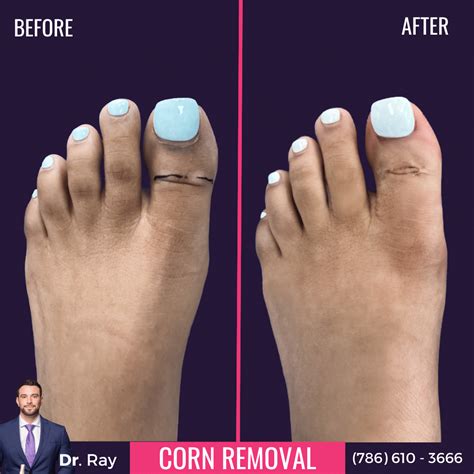 What to Know About Corn Removal Surgery Before And After