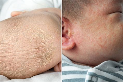Eczema On Baby Scalp