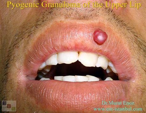 Haemangioma On Lip