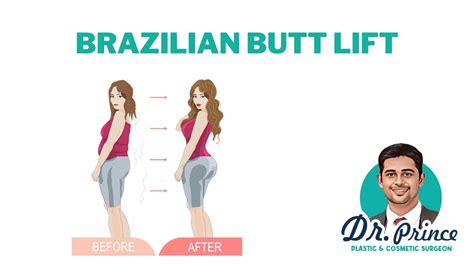 The Art of Curves: Comprehensive Guide to Brazilian Butt Lift (BBL ...