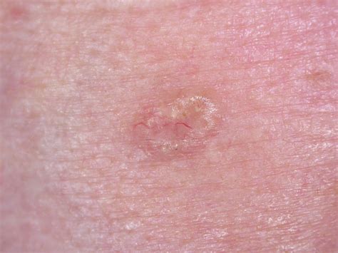Basal Cell Carcinoma Stages Pictures at Gayla Wilson blog