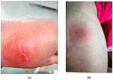 Etoricoxib-Induced Fixed Erythema