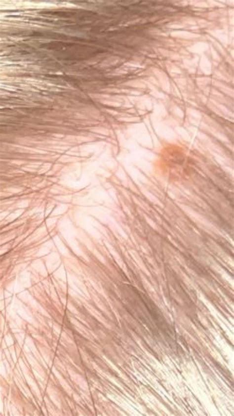 could this be melanoma on my scalp? : r/Melanoma