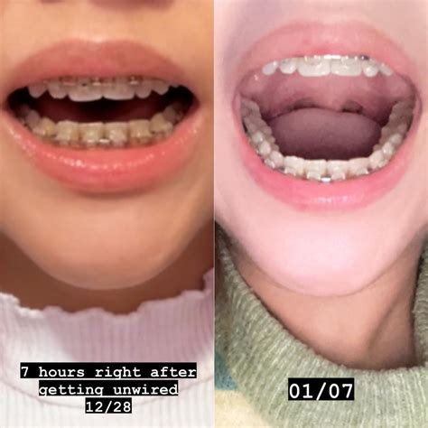 5 Months Post Op — Braces Off : r/jawsurgery
