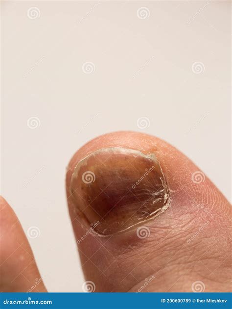 A Bruised Finger after a Blow, a Bruise on the Finger Stock Image - Image of foot, disease ...