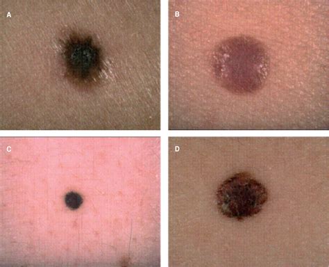 Nodular Melanoma Skin Cancer malignant melanoma - Skin Cancer Pictures - skinetix