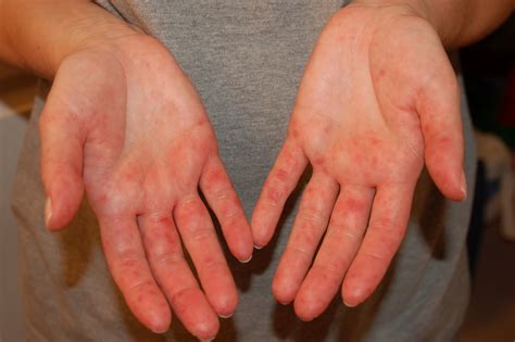 Herpes Simplex