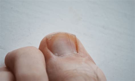 Ingrown Toenail - Top Health Doctors