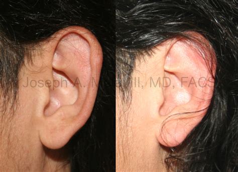 Cauliflower Ear After Surgery