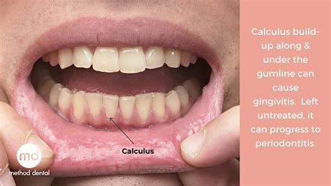 Calculus Teeth