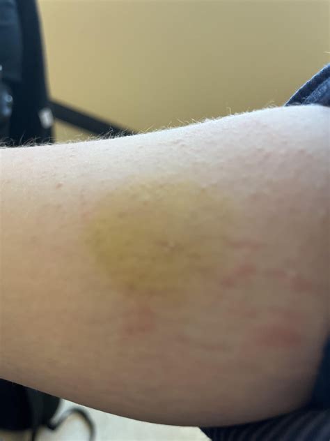 This yellow spot on my arm it used to be a lot smaller and purple : r ...