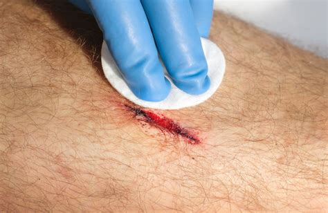 When Can Sutures Be Removed Without Risking by Medico