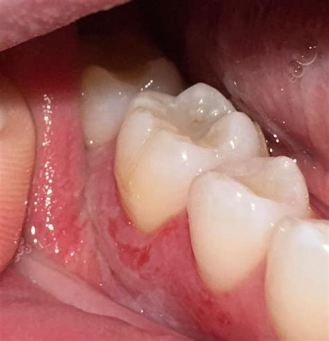 Sore gum/ulcer : r/DentalHygiene