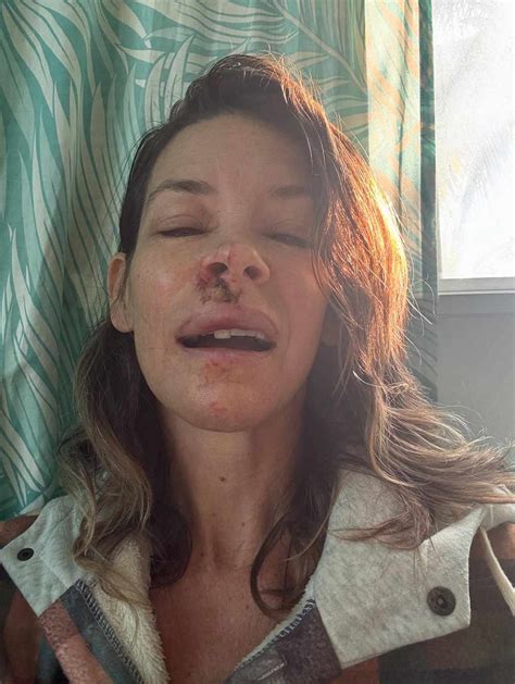 Evangeline Lilly Shares Photos After Fainting, Hitting Her Face on Boulder