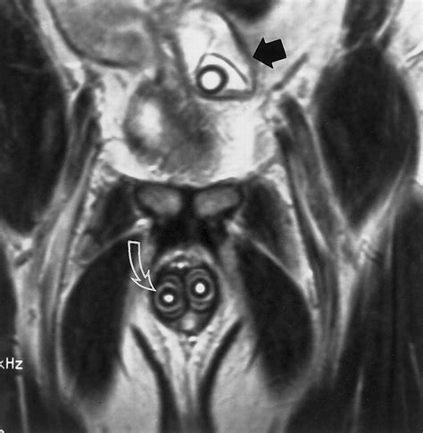 MR Imaging of the Penis | RadioGraphics