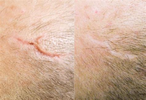 Scar Removal Surgery | Best Surgical Scar Removal Australia | Cutis Clinic