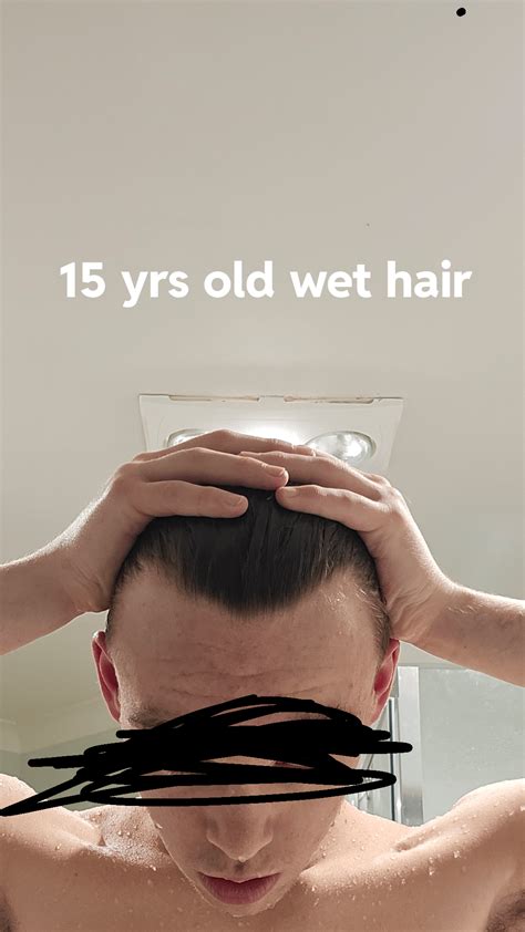 Balding or normal but messed up hairline? M15 : r/Hairloss