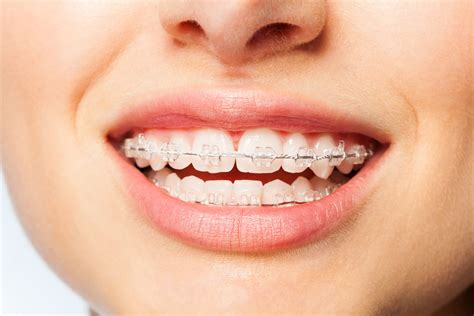 Braces in Brisbane | Experienced Braces Dentist | Tony Weir Orthodontist