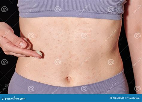 Red Allergic Rash on Belly Skin, Atopic Dermatitis, Eczema, Inflammation. Woman Applying ...