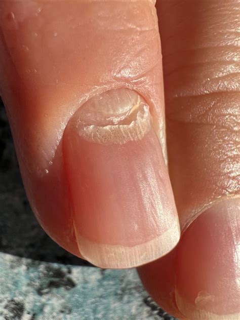 My partners nail stopped growing, then restarted growing underneath the ...