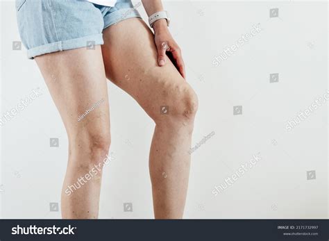 6,368 Varicose_vein_pain Images, Stock Photos & Vectors | Shutterstock