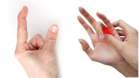 Sticky fingers: what to do about trigger finger and mallet finger - The Portland Clinic